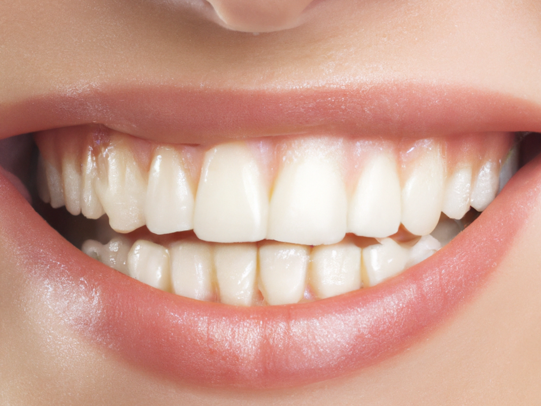 Capa: Receita Caseira Para Clarear os Dentes: Mitos e Verdades — foto: Kasim H/Pexels